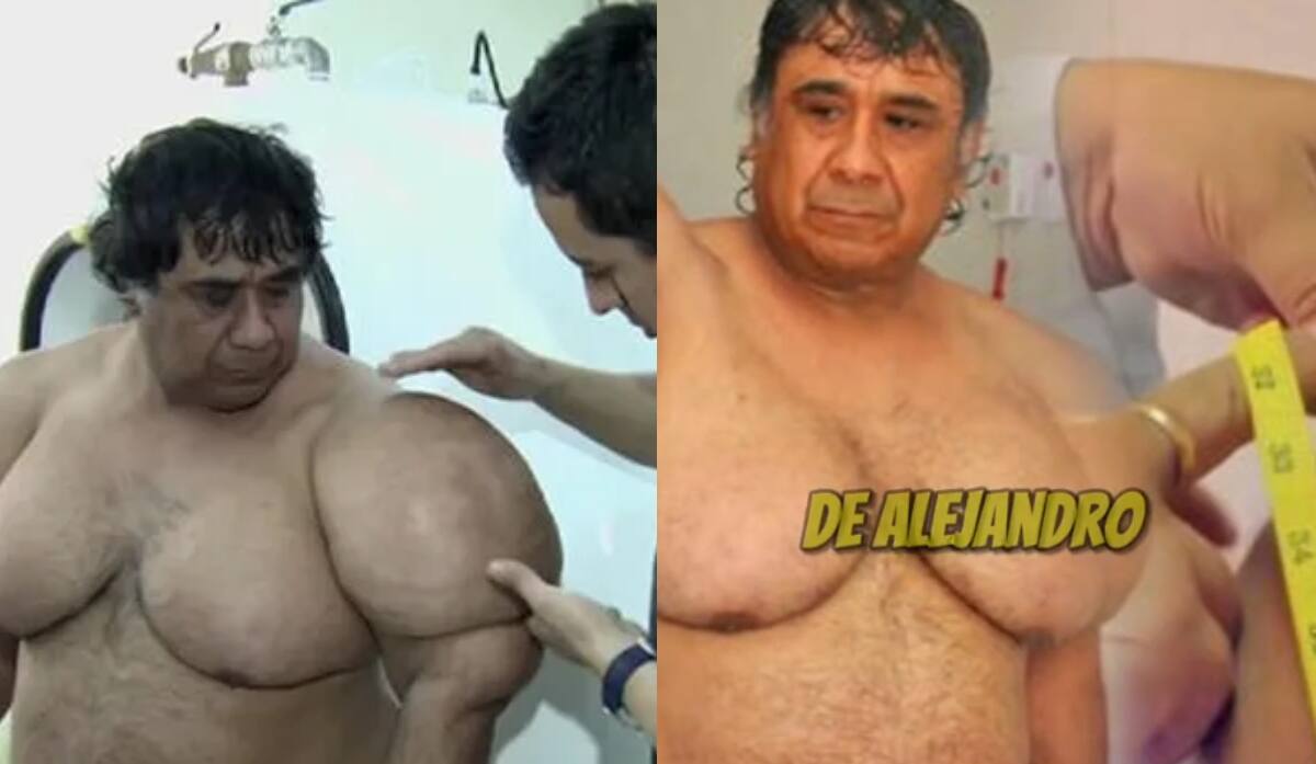 Este hombre quedo inflado debido a esta condición, era buzo anteriormente