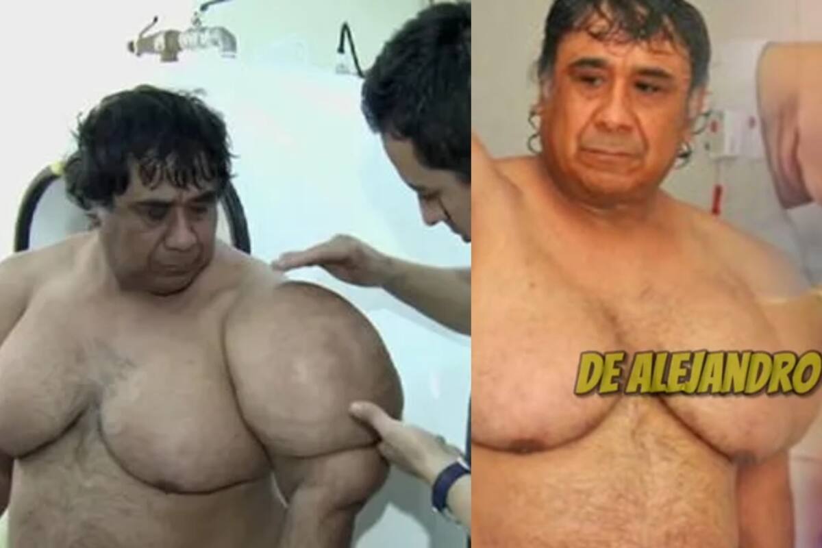 Este hombre quedo inflado debido a esta condición, era buzo anteriormente