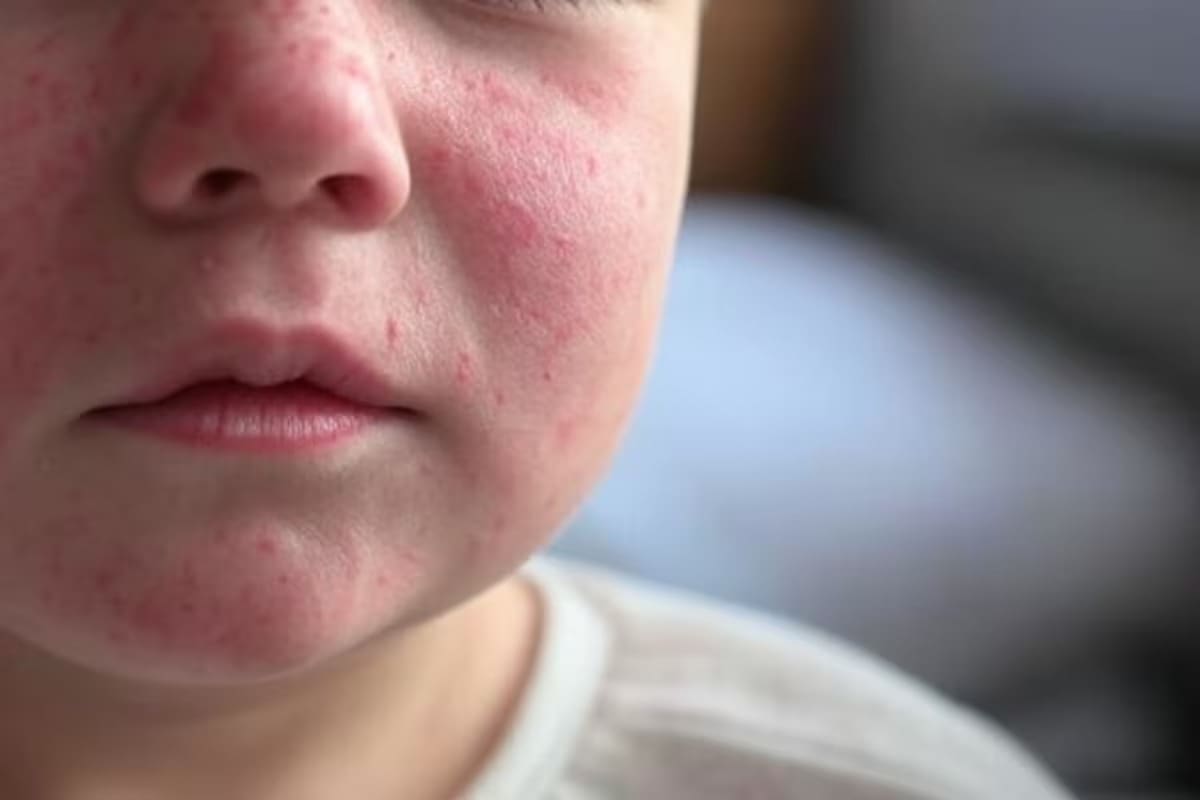 Hasta la fecha, Baja California, se mantiene libre de casos de sarampión, de acuerdo a información actualizada de la Secretaría de Salud l Foto: Cortesía