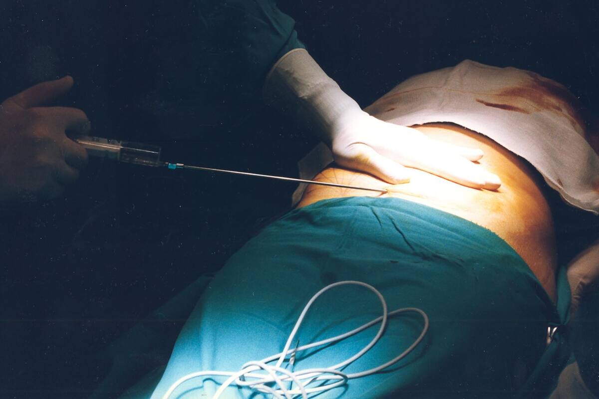 Muere mujer horas después de someterse a una liposucción