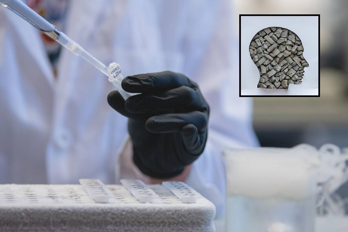 Medicamento contra el cáncer podría ayudar a tratar el Alzheimer en las primeras etapas