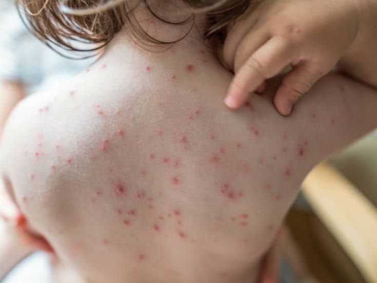 BC cerró 2025 con 21 casos confirmados de sarampión