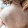 Un recién nacido no vacunado murió tras dar positivo a sarampión en Pensilvania y forma parte de los dos fallecimientos asociados al virus en el estado en 35 años