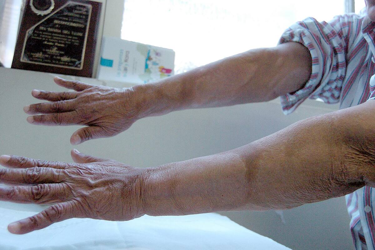 Lavado de manos es clave para evitar la lepra