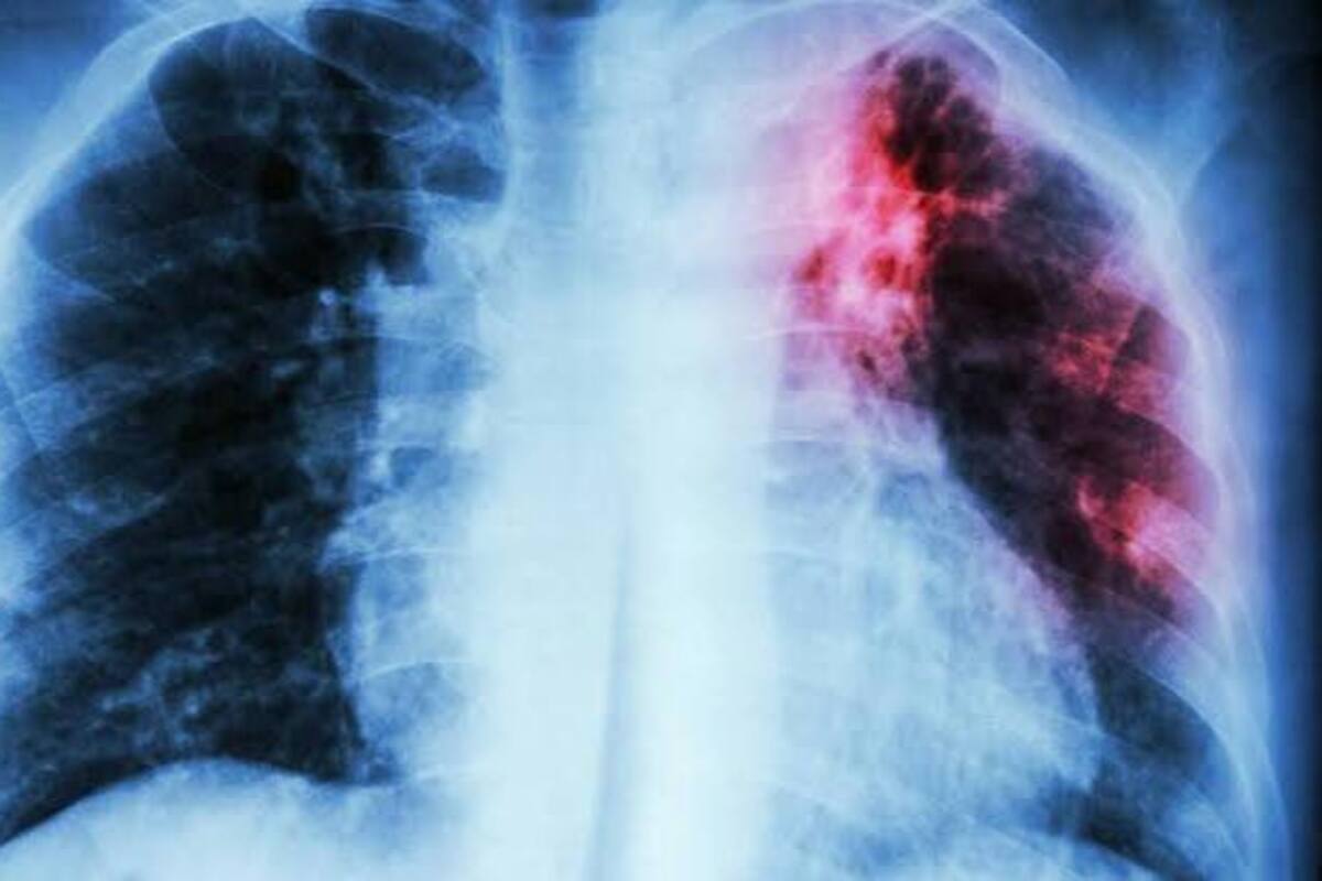 Pacientes con fibrosis pulmonar idiopática pueden desarrollar cáncer pulmonar