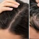 ¿Psoriasis o caspa? Estas son las diferencias que debes conocer para identificarlas correctamente