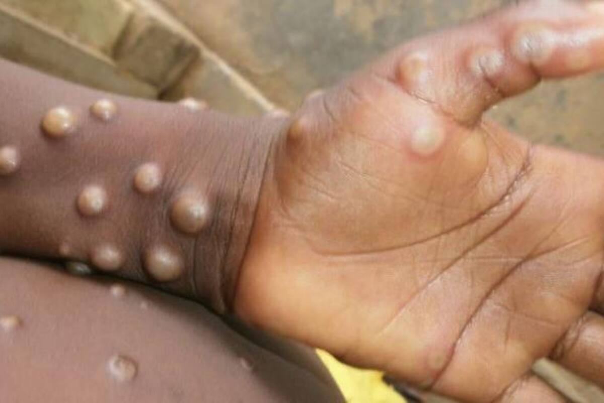 Viruela del mono: Comité de emergencia de la OMS se reúne para evaluar brote