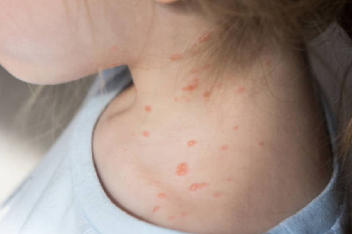 Baja California confirma 15 casos de sarampión en febrero