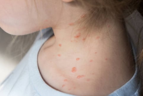 ¿Qué darle de comer a un niño con sarampión? Esto dicen los expertos | Foto: Especial