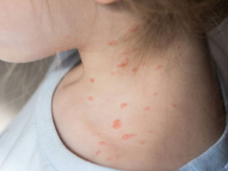 Sonora ha registrado 62 casos de sarampión en 2026: ¿Qué municipios son los más afectados?