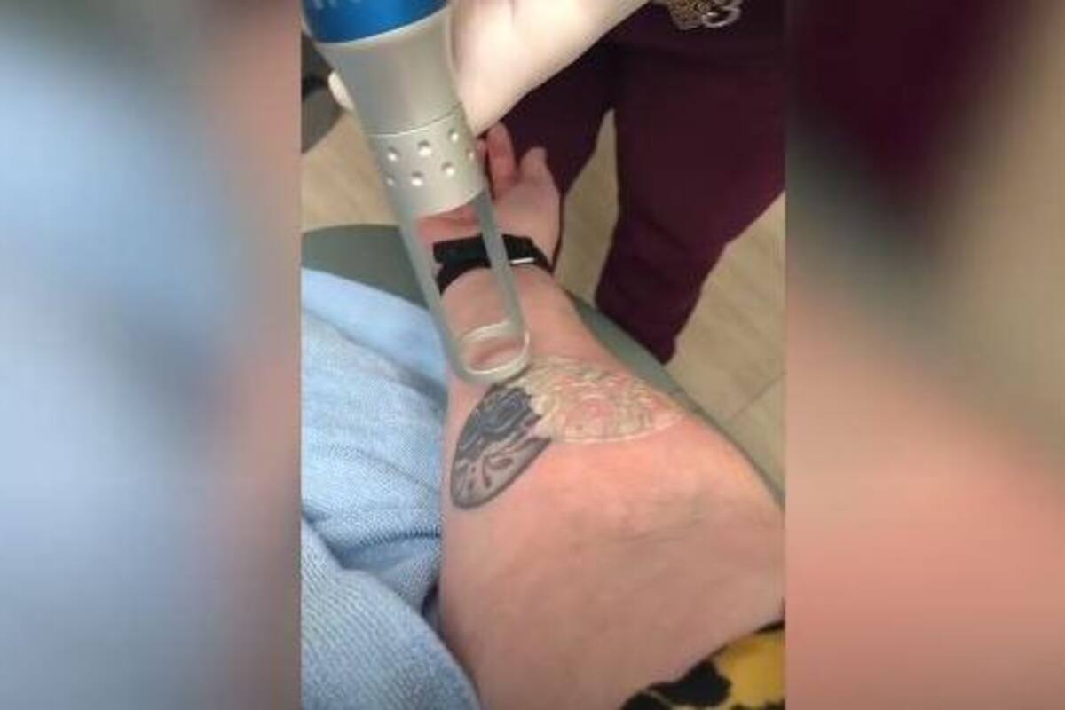 VIRAL: Mujer se decide quitarse el tatuaje de su adolescencia y los internautas se impactaron con las imágenes