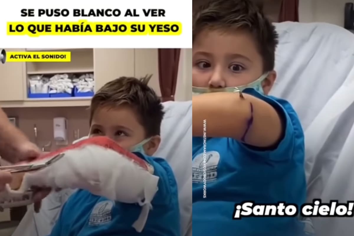 Niño se asusta al retirarle el yeso y descubrir una estructura metálica bajo la piel: ¿qué es realmente?