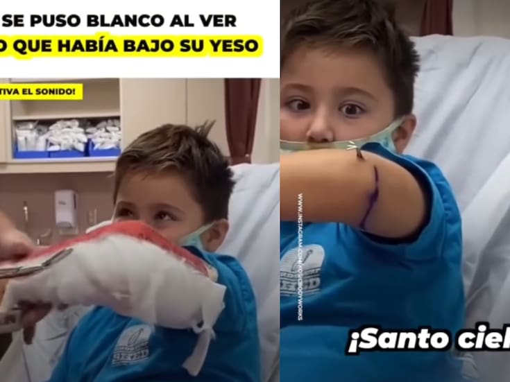 Niño se asusta al retirarle el yeso y descubrir una estructura metálica bajo la piel: ¿qué es realmente?