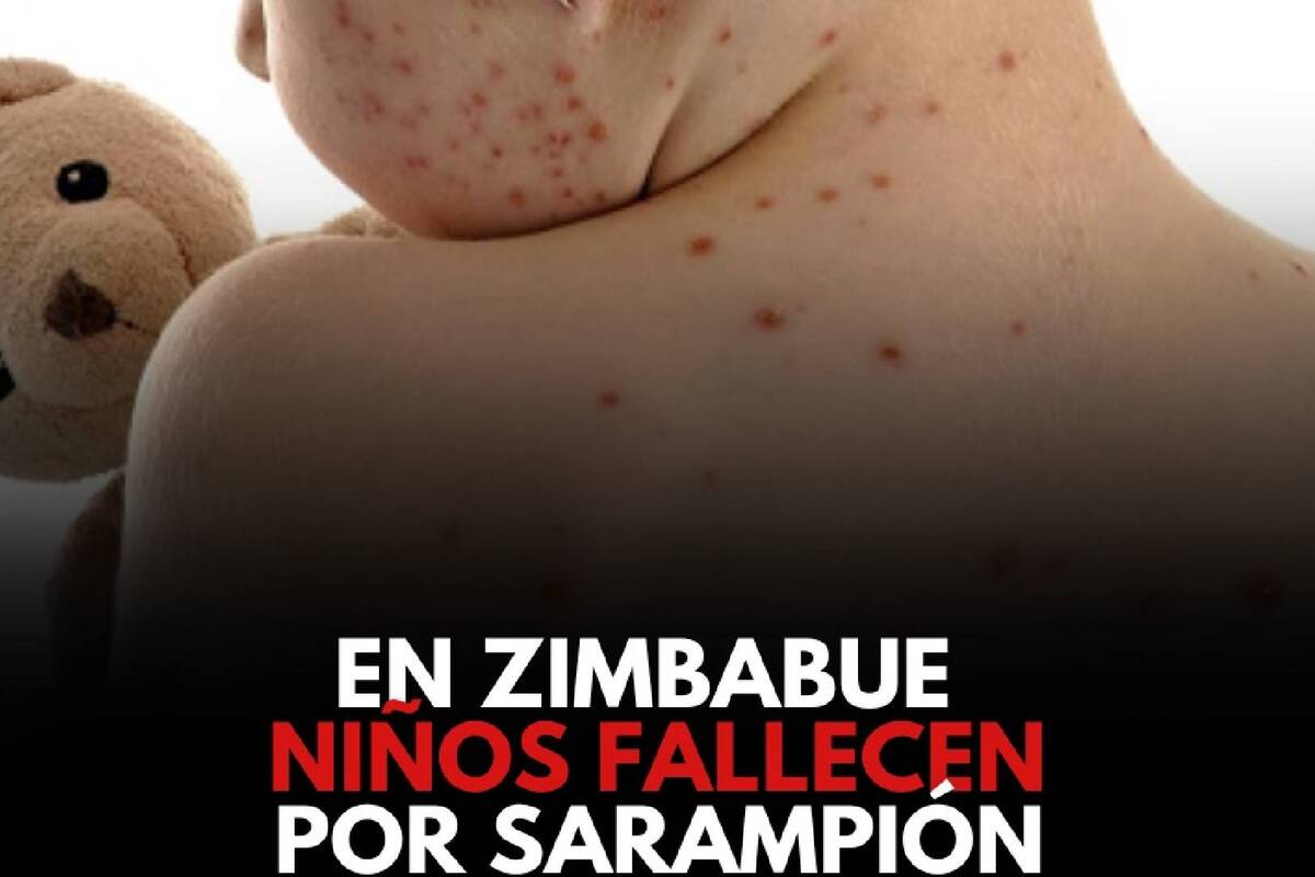 En Zimbabue han muerto al menos 157 menores por sarampión