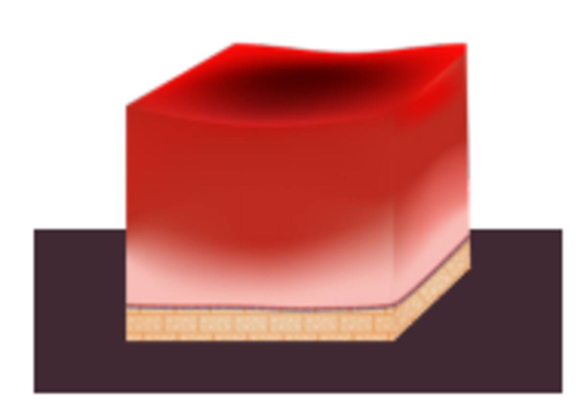 Quemadura de tercer grado. / PROFECO.