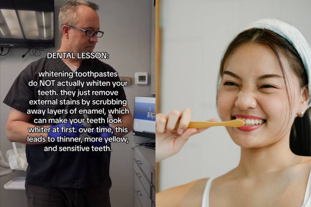 TikTok: Dentista advierte sobre el uso de pastas blanqueadoras