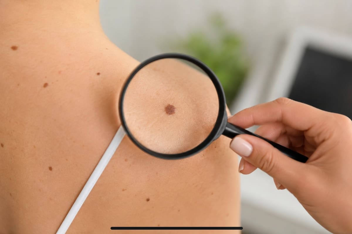 Si notas este aspecto en alguno de tus lunares, debes acudir rápidamente al médico