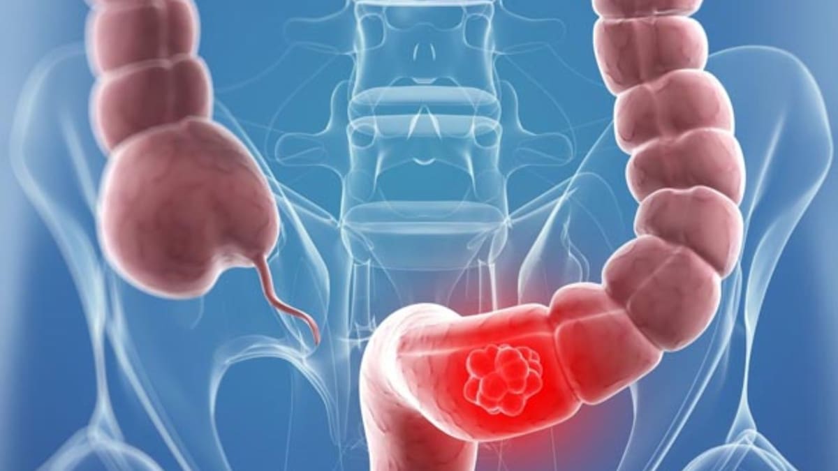 Las nuevas guías de la Sociedad Americana contra el Cáncer explican cómo detectar el cáncer de colon mediante una prueba de sangre alternativa, un método que eleva la sobrevida al 90% si es oportuno