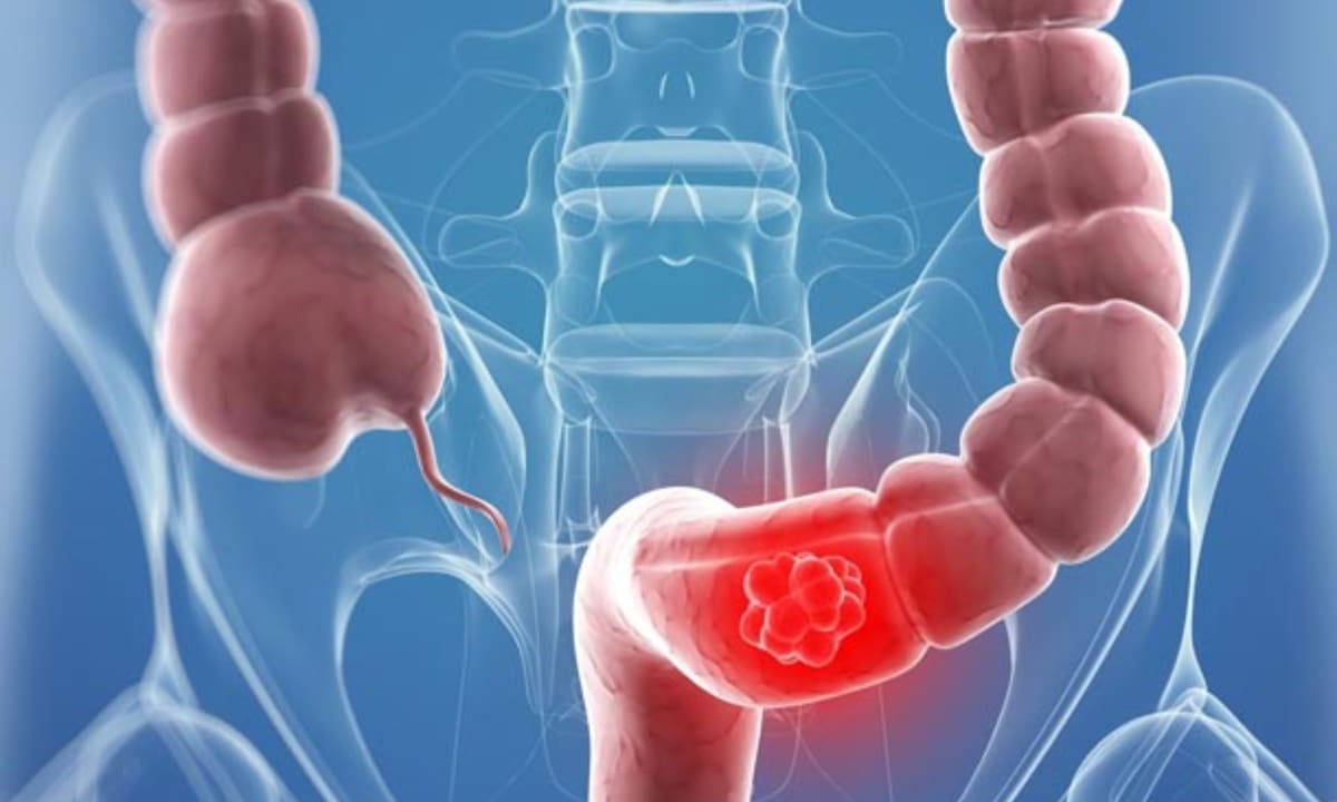 Las nuevas guías de la Sociedad Americana contra el Cáncer explican cómo detectar el cáncer de colon mediante una prueba de sangre alternativa, un método que eleva la sobrevida al 90% si es oportuno | Archivo GH