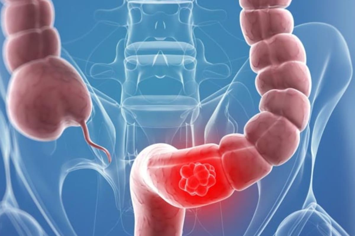 Las nuevas guías de la Sociedad Americana contra el Cáncer explican cómo detectar el cáncer de colon mediante una prueba de sangre alternativa, un método que eleva la sobrevida al 90% si es oportuno