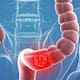 Las nuevas guías de la Sociedad Americana contra el Cáncer explican cómo detectar el cáncer de colon mediante una prueba de sangre alternativa, un método que eleva la sobrevida al 90% si es oportuno