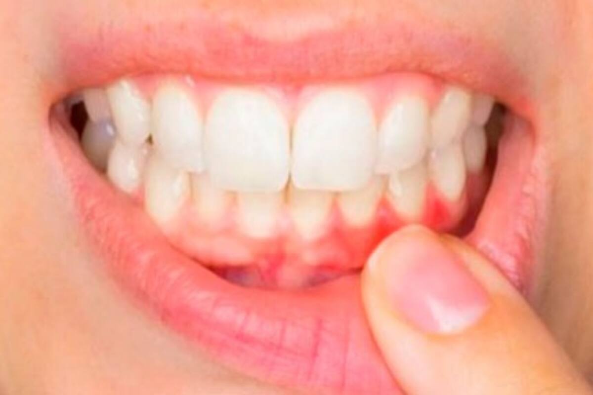 Descubre cómo evitar el sangrado de encías