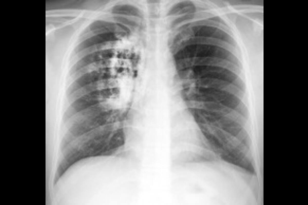 Mata cáncer de pulmón a 222 en un año