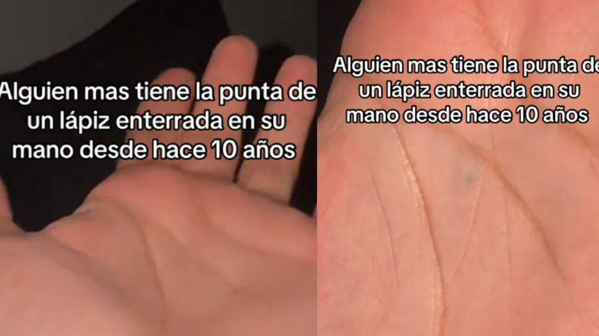 Hombre se viraliza por mostrar la punta de un lapiz enterrada en su mano; la tiene desde los 10 años
