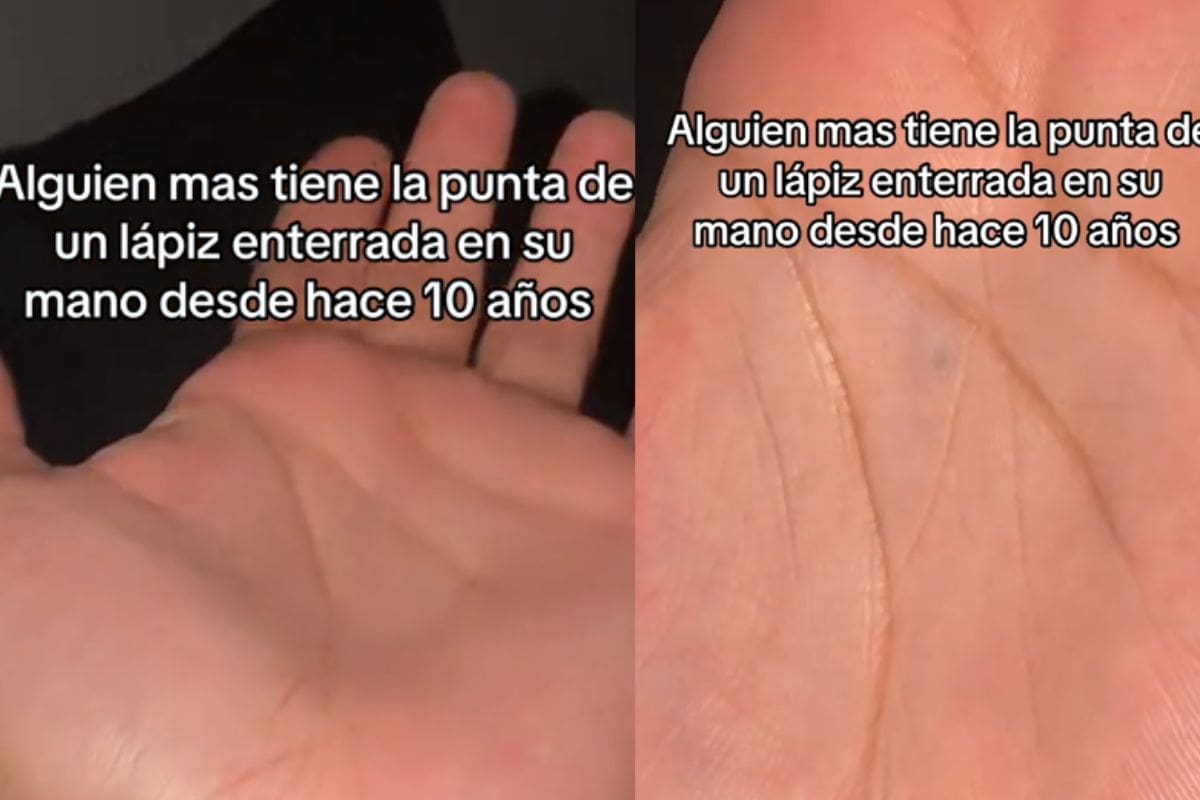 Hombre se viraliza por mostrar la punta de un lapiz enterrada en su mano; la tiene desde los 10 años