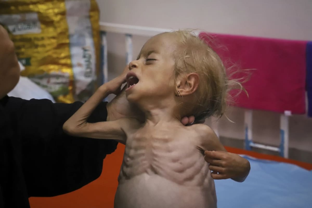 Islam Qudeih muestra a su hija de 2 años, Shamm, gravemente desnutrida y sin camisa, a los periodistas en el Hospital Nasser de Khan Younis, al sur de la Franja de Gaza, el sábado 9 de agosto de 2025. | Crédito: AP/Mariam Dagga