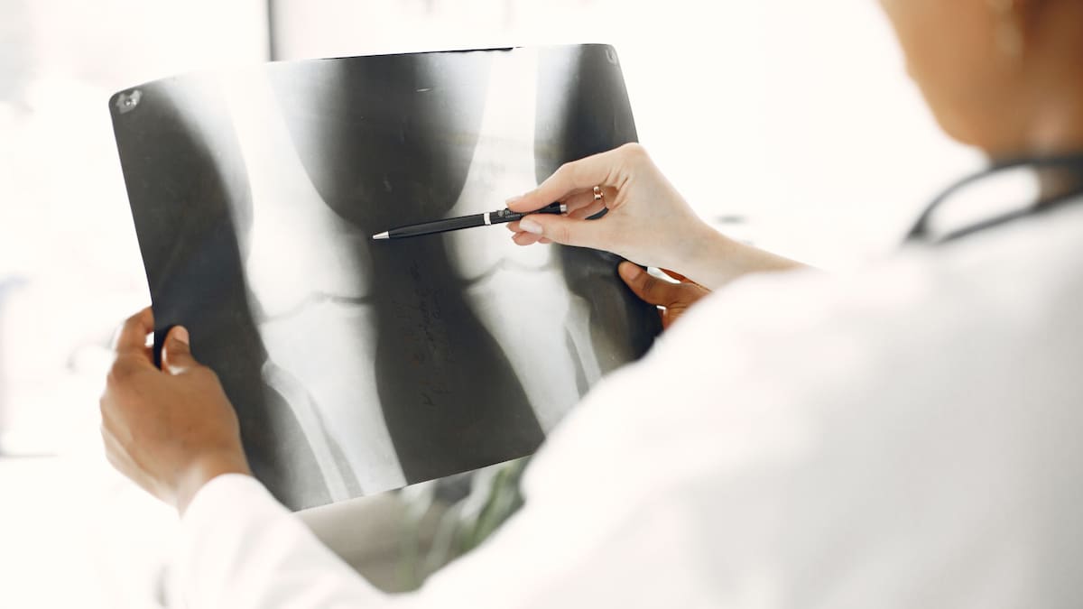 Por qué algunas personas nunca se fracturan un hueso | Foto: Especial (canva)