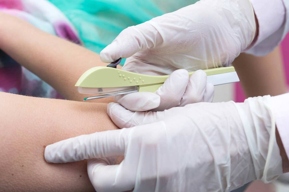 Le colocan implante anticonceptivo y se le va al pulmón