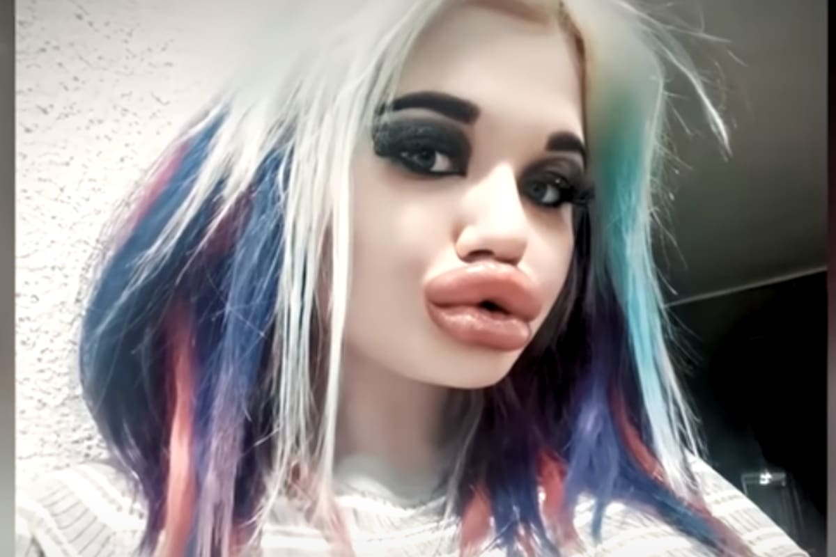 Mujer quería tener los mejores labios para ser más bella y termina siendo deforme