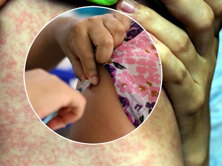 México compra 27.3 millones de vacunas contra el sarampión y refuerza campaña nacional ante aumento de contagios, autoridades explican quiénes deben vacunarse y cómo funciona el esquema de protección