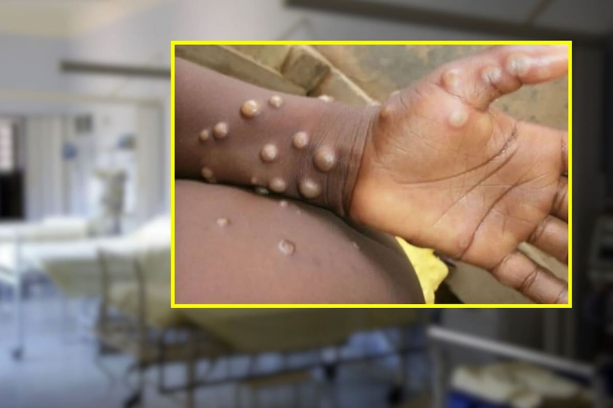 SSP confirma dos casos de MPOX en Sonora
