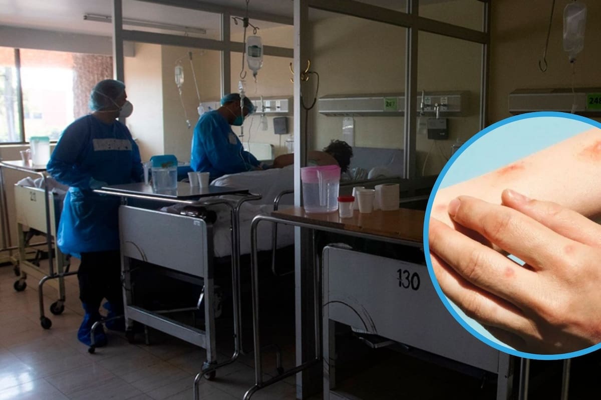 ¿En qué partes de México hay casos positivos de Mpox (viruela del mono)?