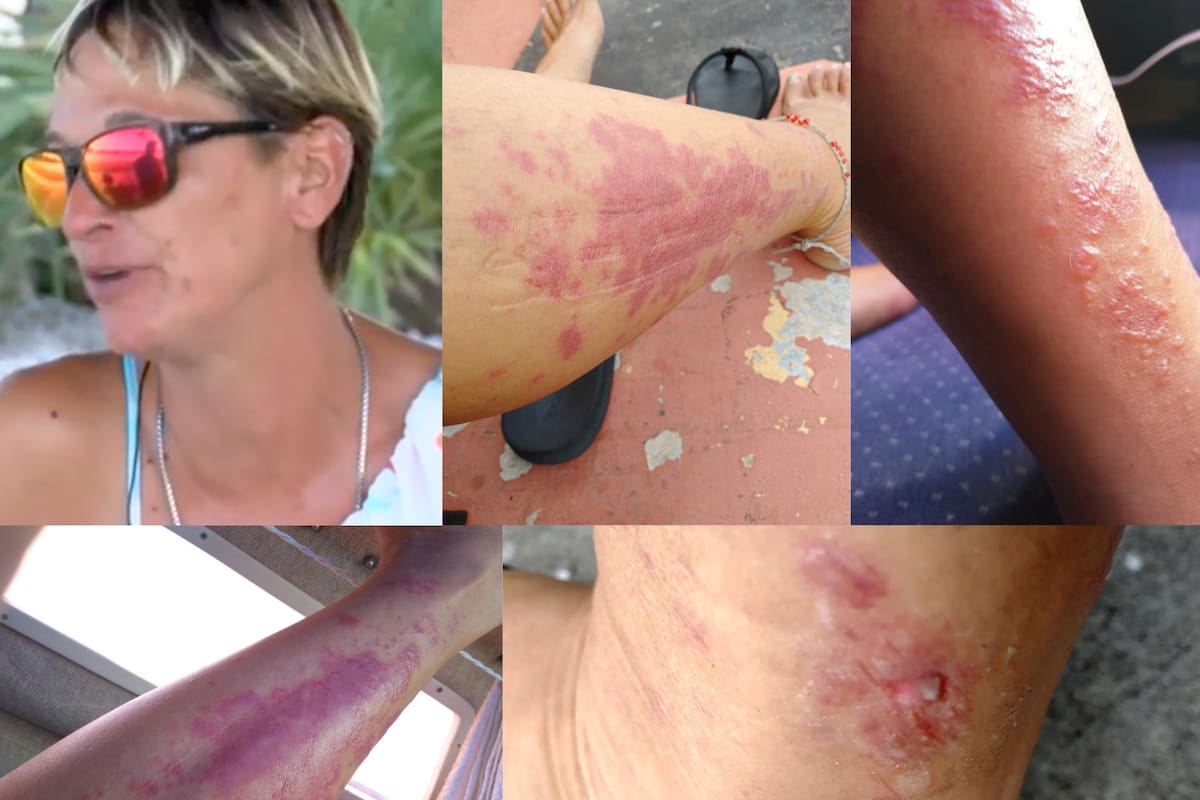 Mujer se infecta de bacteria “come carne” en playa del Golfo de México