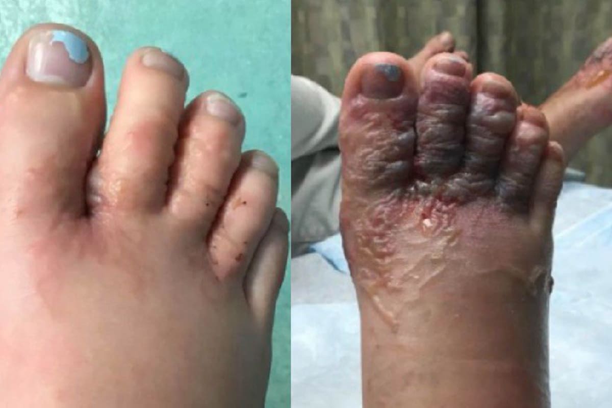 ¿Es real la foto del pie infestado por larvas de heces de perros?