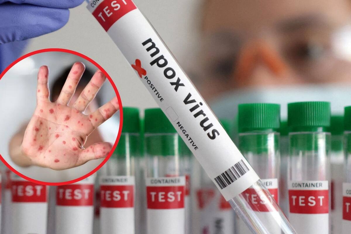 Cofepris aprueba “Jynneos” vacuna contra mpox en México