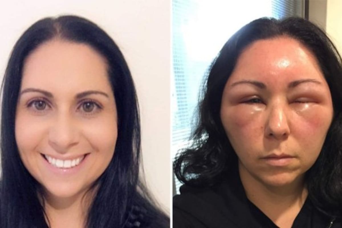 Mujer sufre severa reacción alérgica por tinte para cabello