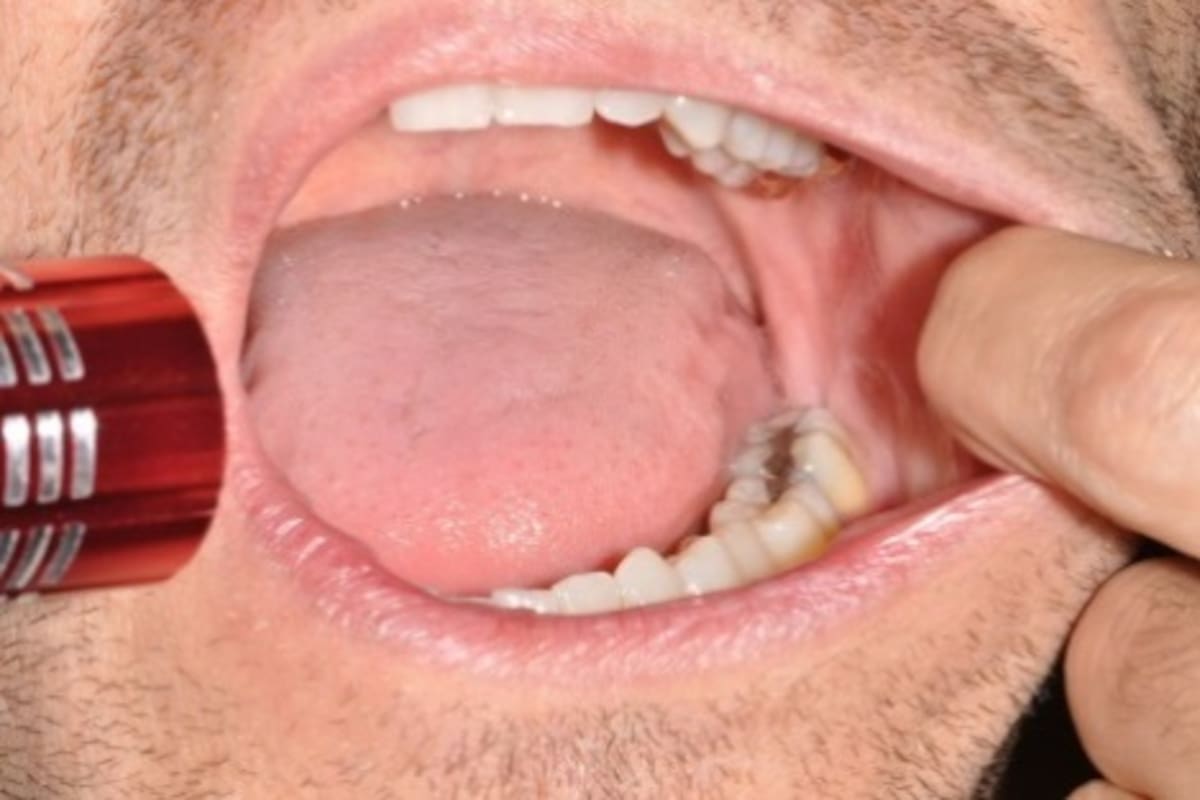 Estos hábitos pueden causar cáncer de garganta y boca