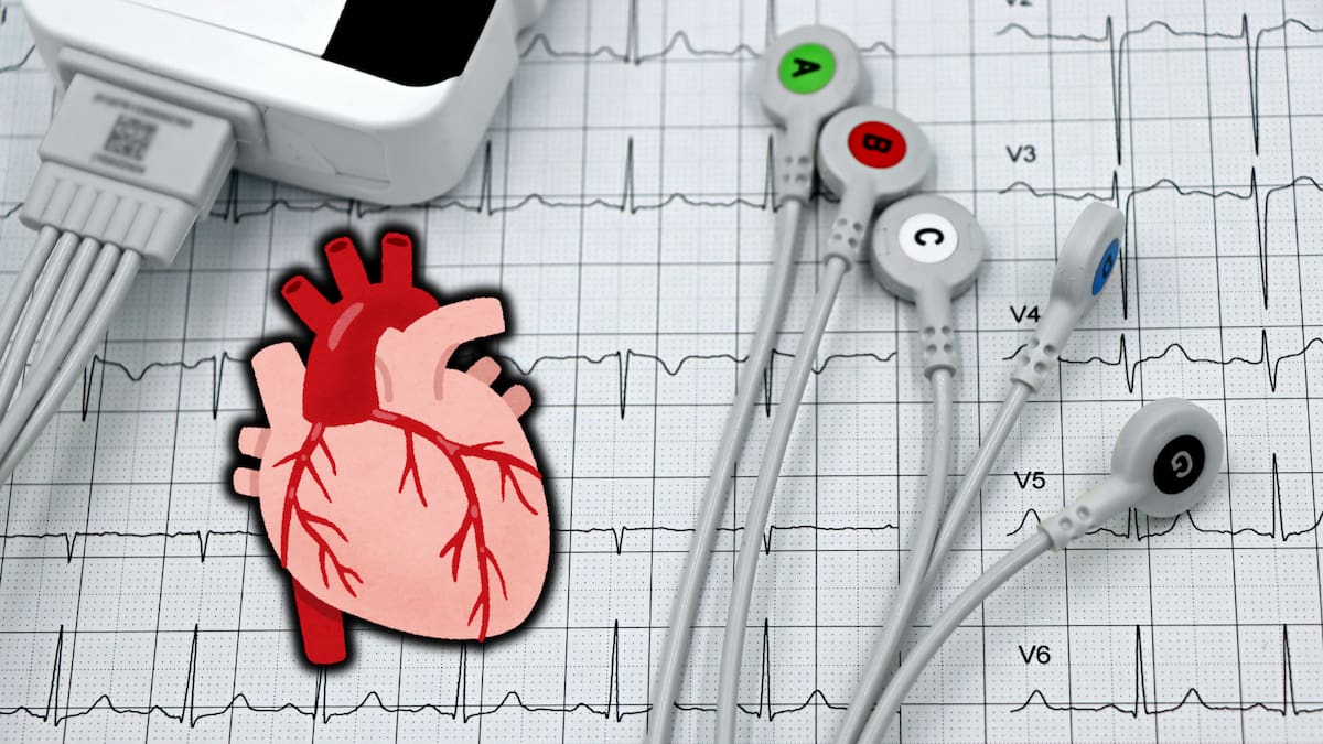 Un estudio internacional con más de 9,3 millones de historias clínicas confirmó que la mayoría de los infartos, ACV e insuficiencias cardíacas ocurren en personas con factores de riesgo previos/Foto: Canva