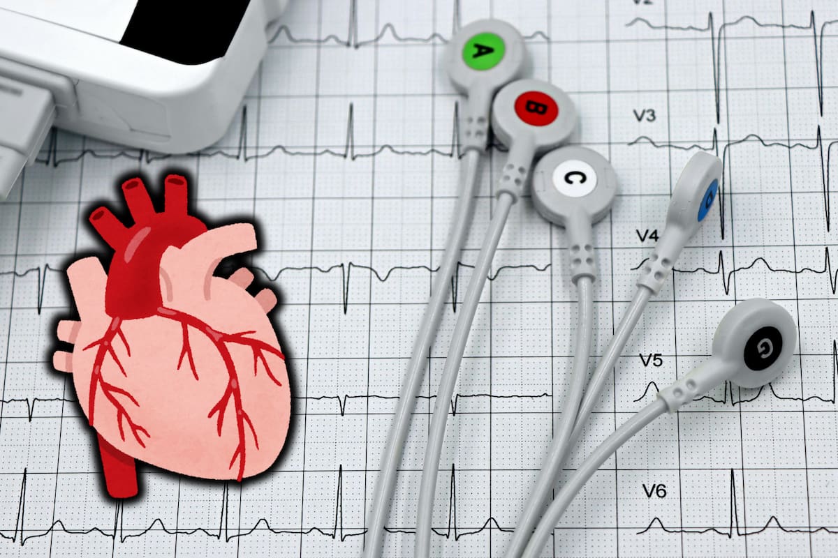 La mayoría de los infartos y ACV ocurren en personas con factores de riesgo previos