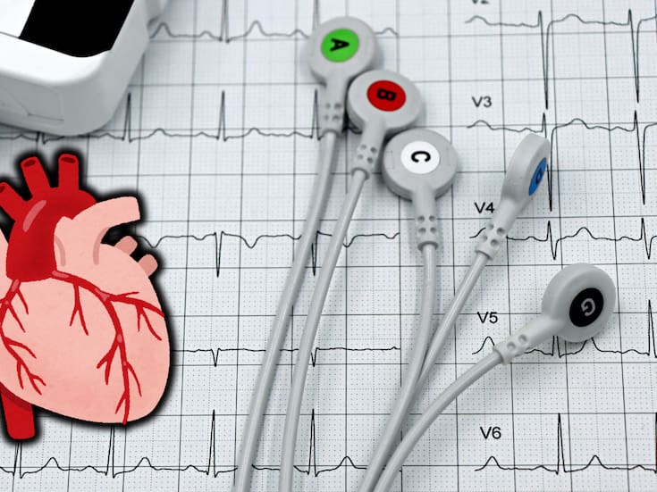 La mayoría de los infartos y ACV ocurren en personas con factores de riesgo previos