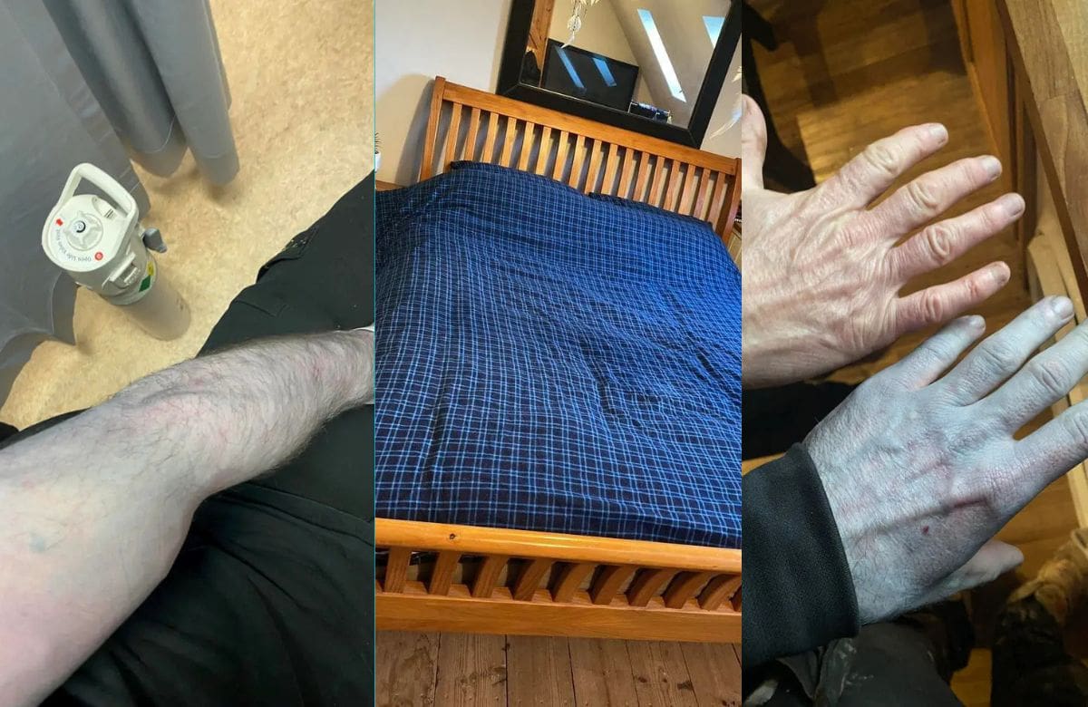 Un obrero en Inglaterra despierta con la piel azul, es trasladado a urgencias de un hospital y los médicos no encuentran ninguna enfermedad | Foto: Tommy Lynch / SWNS