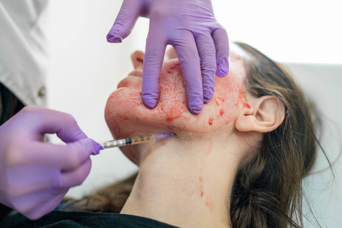 Advierten sobre ilegalidad de 'facial vampiro' en BC