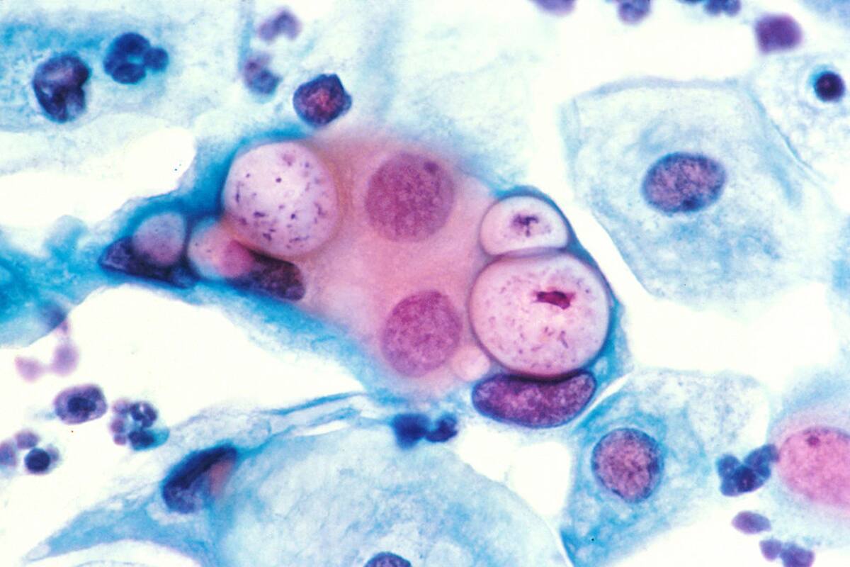 ¿Qué es la infección por clamidia y cómo sé si la tengo?