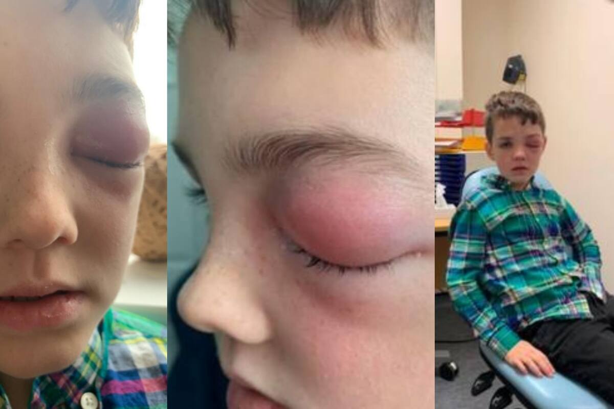 "Ojo Covid": Niño sufre extraño síntoma por coronavirus