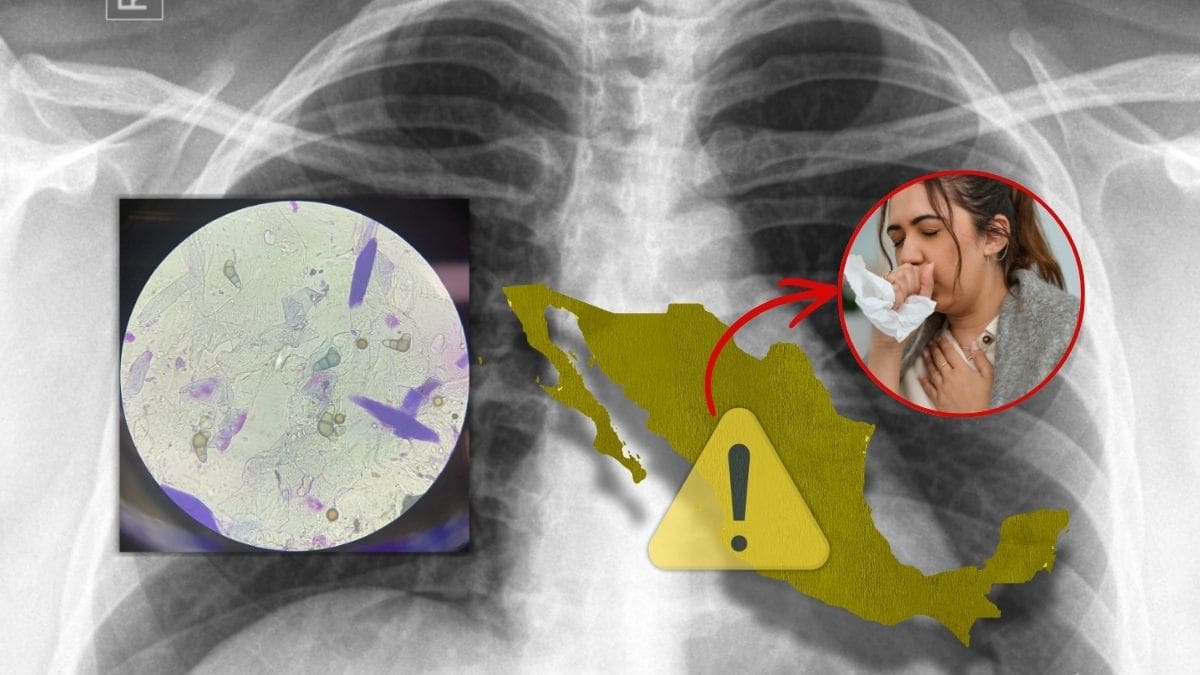 Aumenta la Tuberculosis en México este 2026 mientras el país enfrenta brote de sarampión: estos son los estados con más contagios y qué recomiendan las autoridades