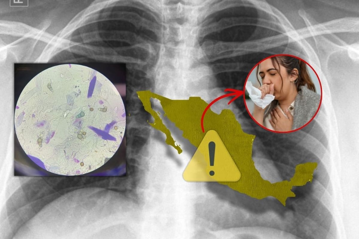 Aumenta la Tuberculosis en México este 2026 mientras el país enfrenta brote de sarampión: estos son los estados con más contagios y qué recomiendan las autoridades